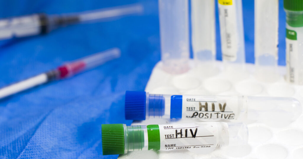 HIV Positive Result